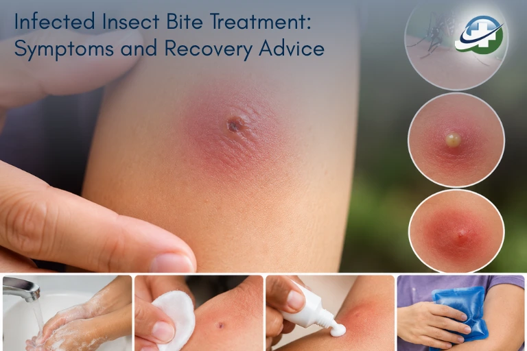 Impetigo Treatment UK